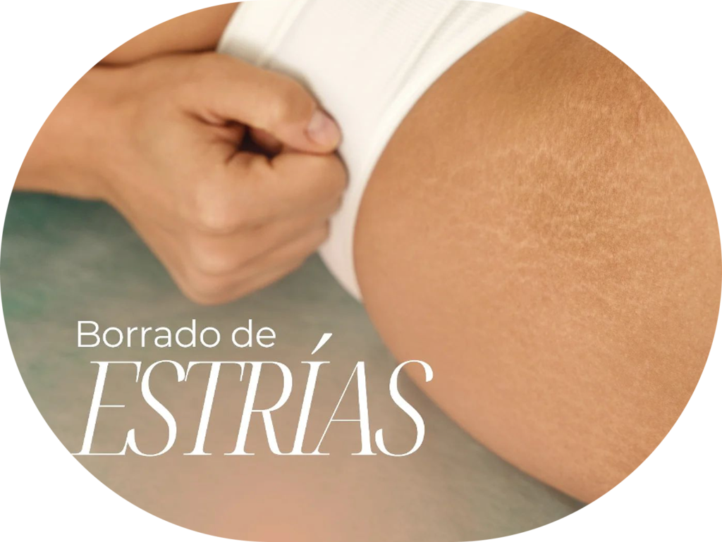 Imagen de borrado de estrías